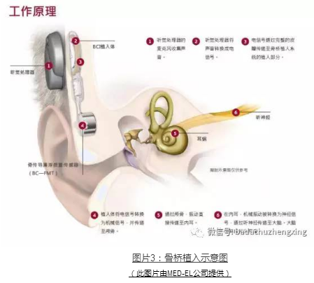 微信 小耳福音：我院開展耳廓整形+聽力重建一站式手術(shù)治療3(1).jpg